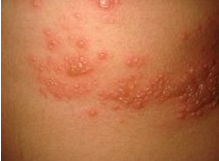 夏季引起汗疱疹的病因有什么呢?